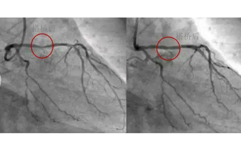 深圳市模具廠對心臟支架的關(guān)注，國產(chǎn)化的道路有多長？